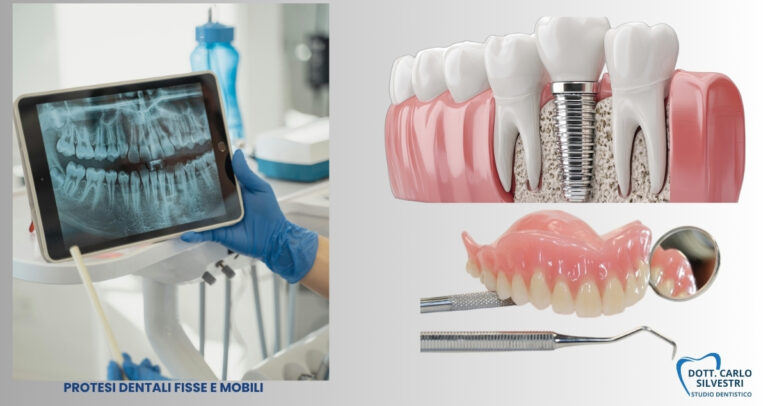 Realizzazione protesi dentarie fisse e mobili a Marsciano: soluzioni su misura per ritrovare il sorriso